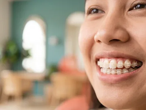 Behel / Kawat Gigi